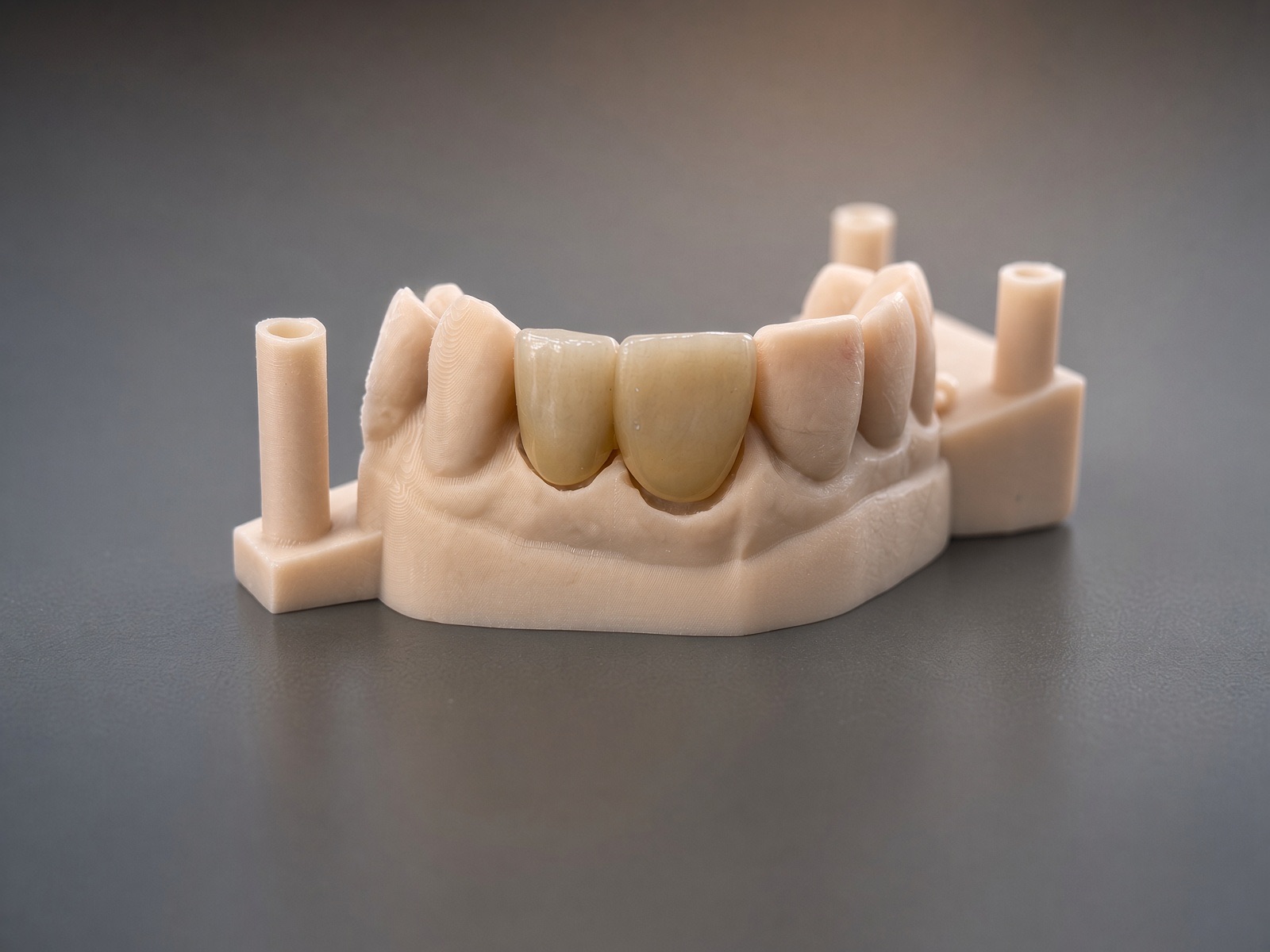 Couronnes full zircone sur modèle 3D