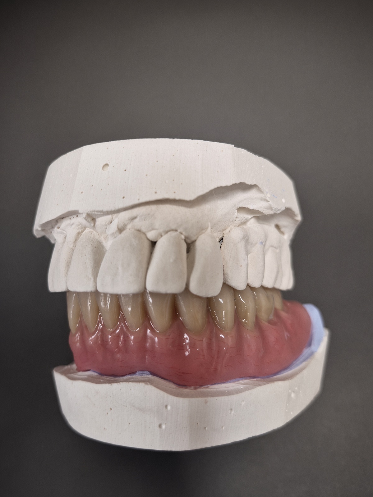 Appareil définitif résine mandibulaire, vue en occlusion