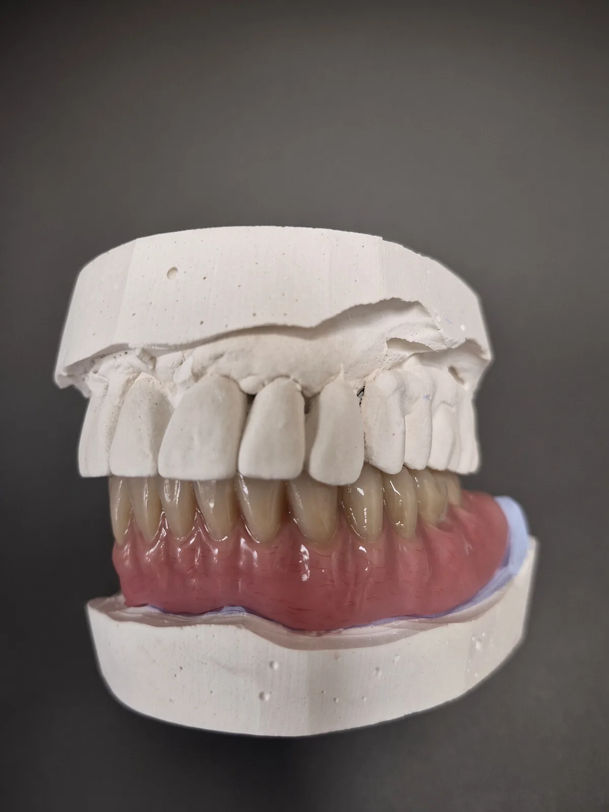 Appareil définitif résine mandibulaire, vue en occlusion